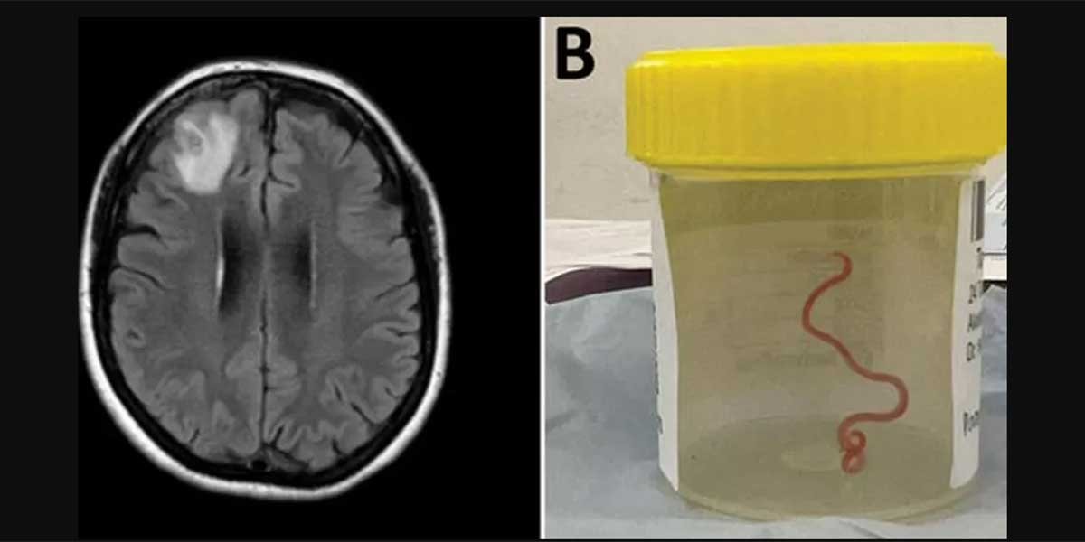 brain brain