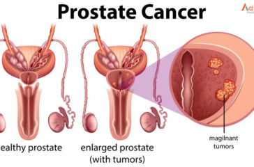 Prostate-Cancer-2-1024x604