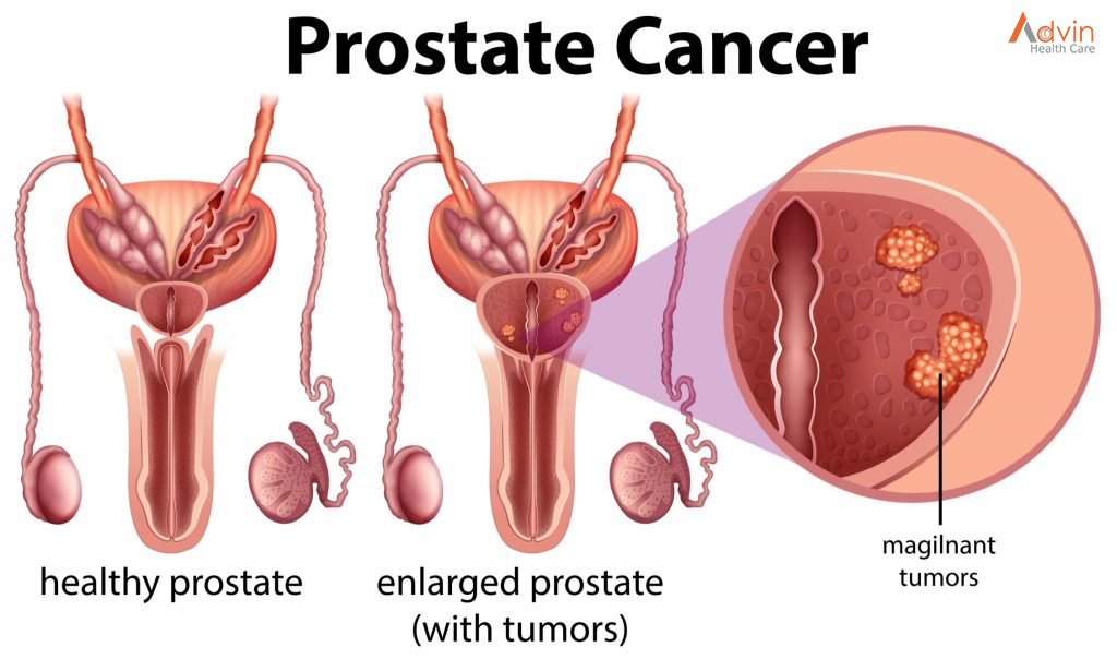 Prostate-Cancer-2-1024x604
