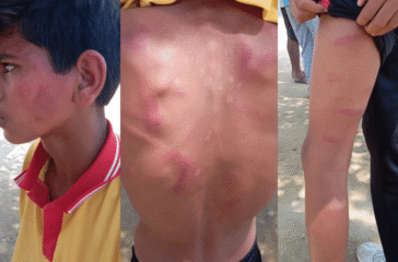 13-year-old student Avinash admitted to hospital after being beaten by teacher