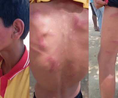 13-year-old student Avinash admitted to hospital after being beaten by teacher