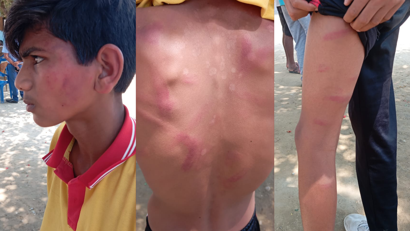 13-year-old student Avinash admitted to hospital after being beaten by teacher